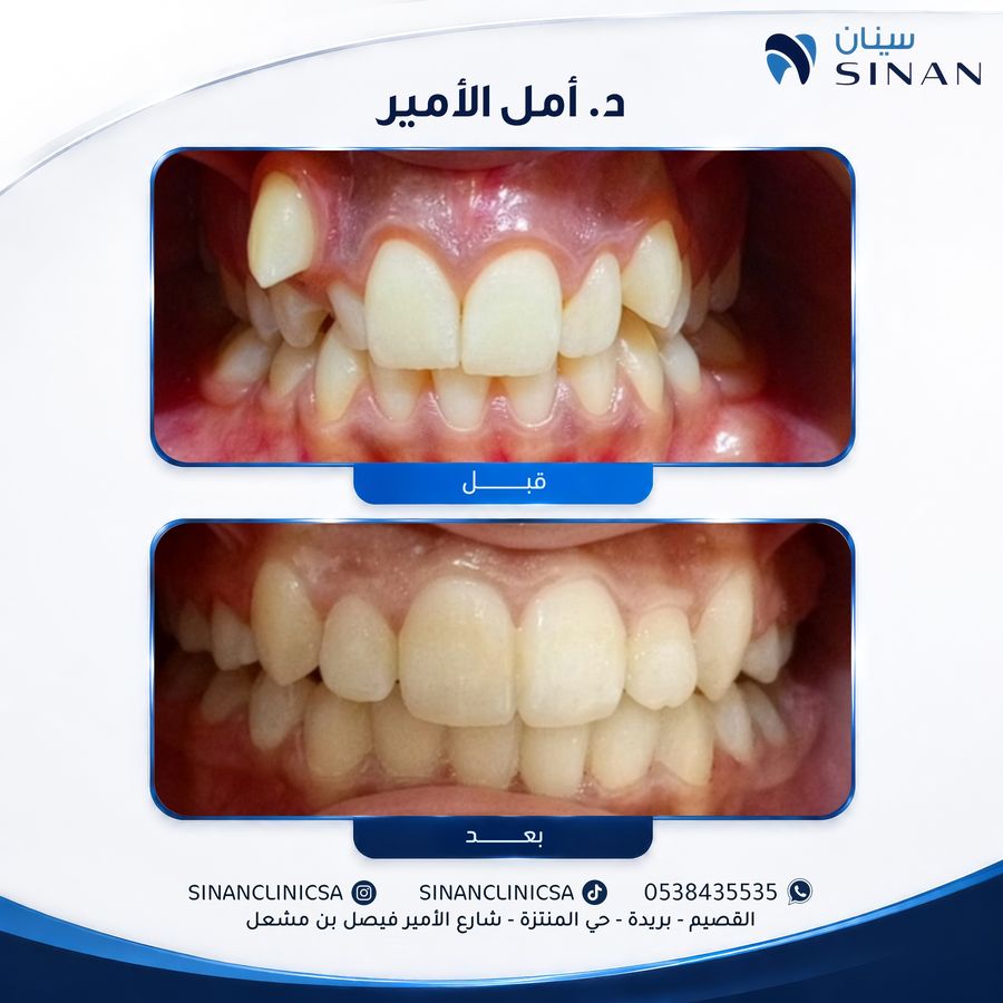 حالة تقويم أسنان قبل وبعد - مجمع سينان بريدة