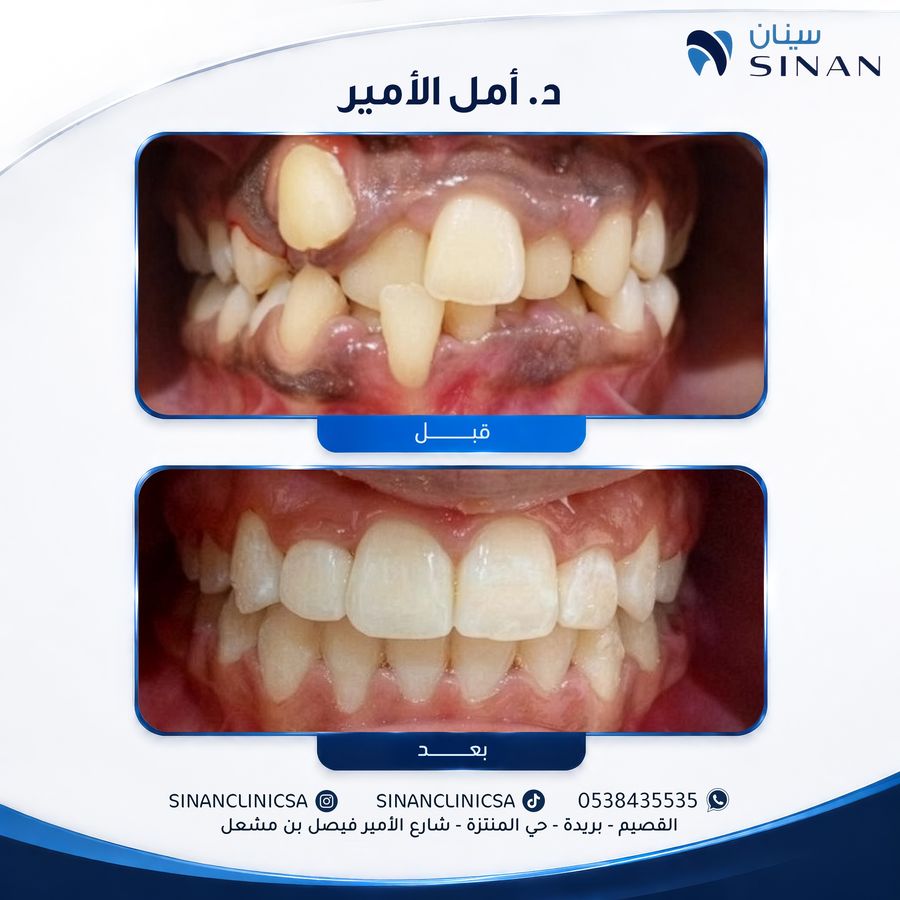 حالة تقويم أسنان قبل وبعد - مجمع سينان بريدة
