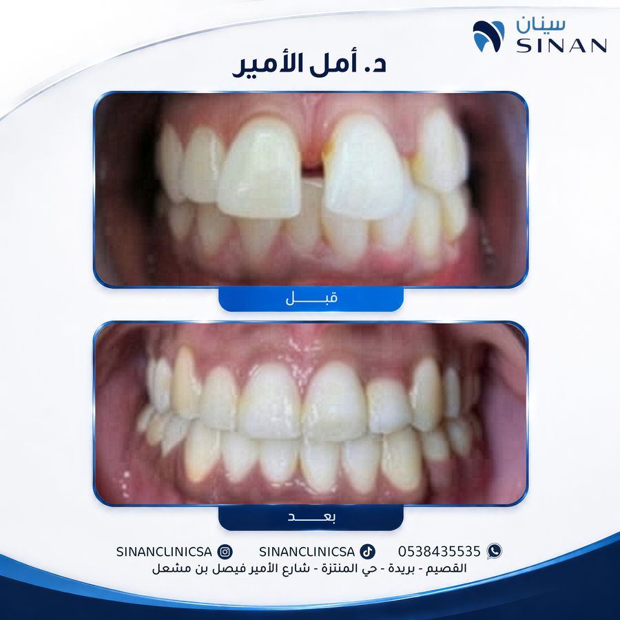 حالة تقويم أسنان قبل وبعد - مجمع سينان بريدة